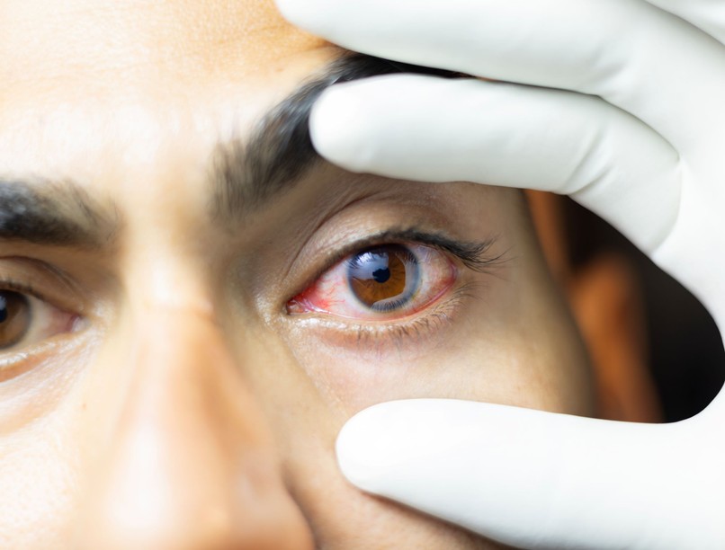 Szemszárazság könny irritáció cukorbetegség