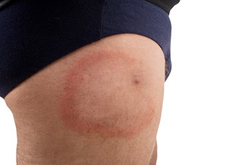 Így néz ki a kullancs csípése