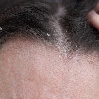 Mi a különbség a zsíros és a száraz korpa között, és mit lehet tenni ellenük? című cikk nyitóképe