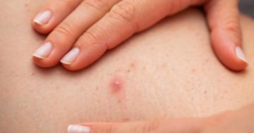 Ha így szőrtelenít, nagyobb az esélye a szőrtüszőgyulladásra