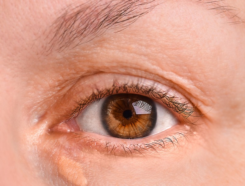 hdl-koleszterin, lerakódás szem körül