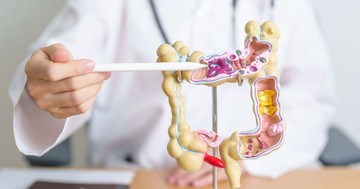  Mitől alakul ki a polip? Az alábbi okok miatt  jelenhetnek meg ezek a jóindulatú képletek 