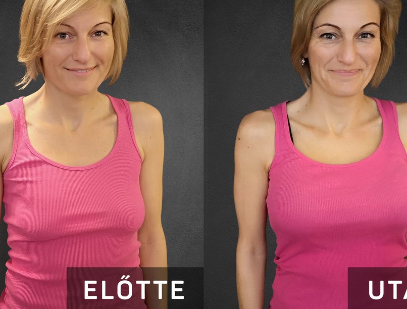 Bernadett a műtét előtt és a műtét után