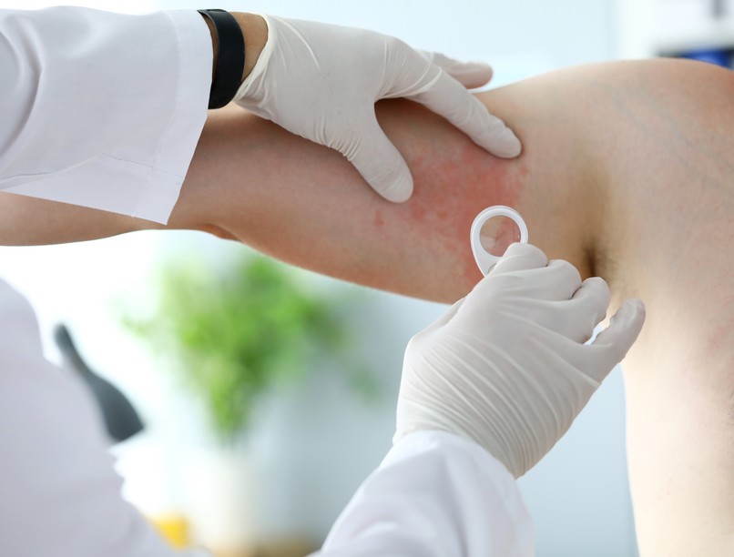 csalánkiütés urtikária vizsgálat menete