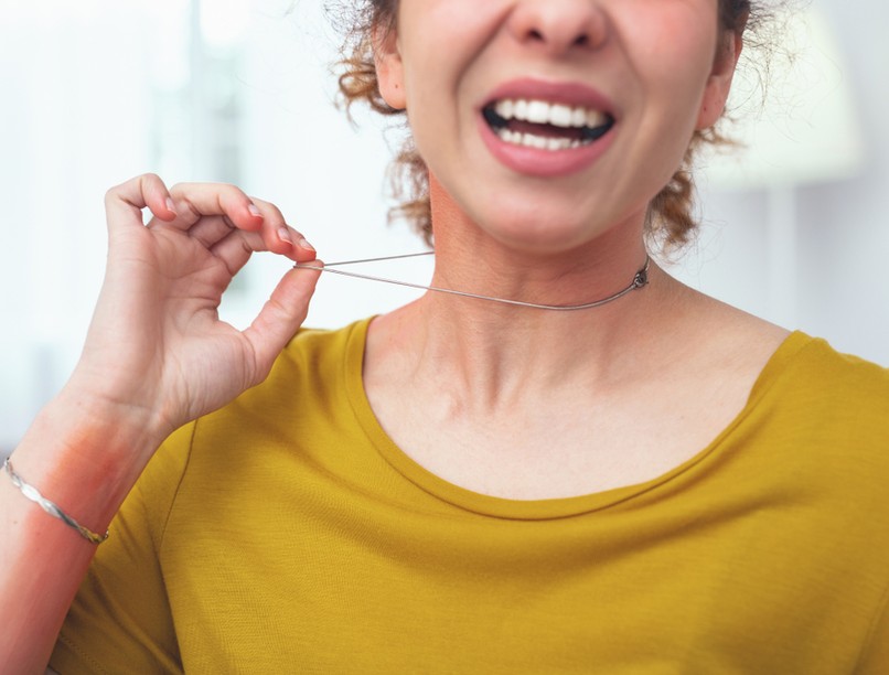 fémallergia, tünetei, kezelése, kivizsgálás, viszketés, epicutan teszt