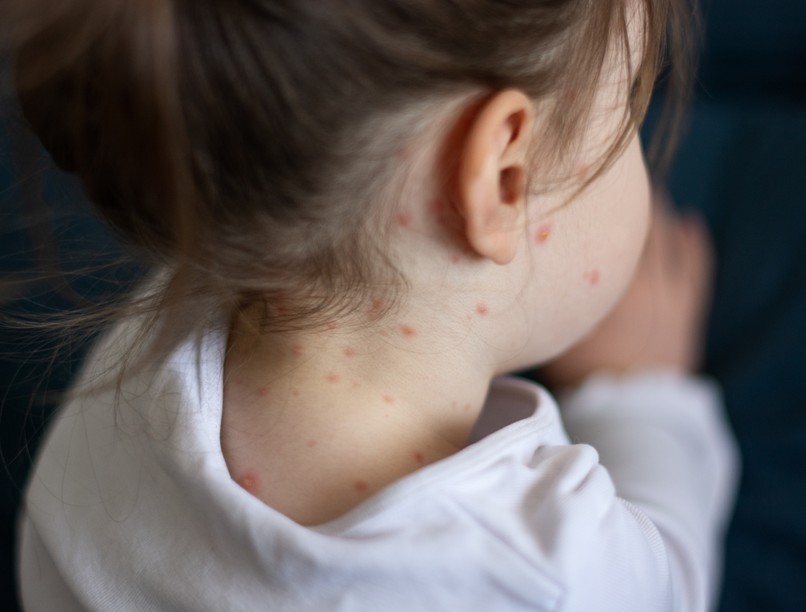 járvány, kanyaró, kanyaró elleni védőoltás