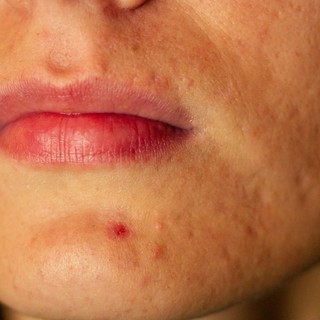 Mit jelez a szervezet az állon megjelenő pattanással? Nem mindig csak bőrprobléma című cikk nyitóképe