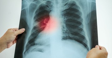  Túl a tüdőgyulladáson– ezért halhat meg valaki a "felépülés" után 