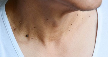  Szemölcs az arcon, a nyakon és a talpon - így írtható ki végleg 