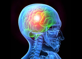 Migrén és genetika