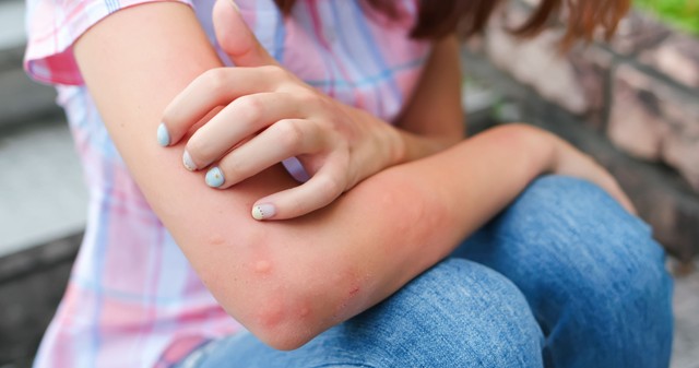 Kiütések strandolás után - ezek okozzák legtöbbször a problémát