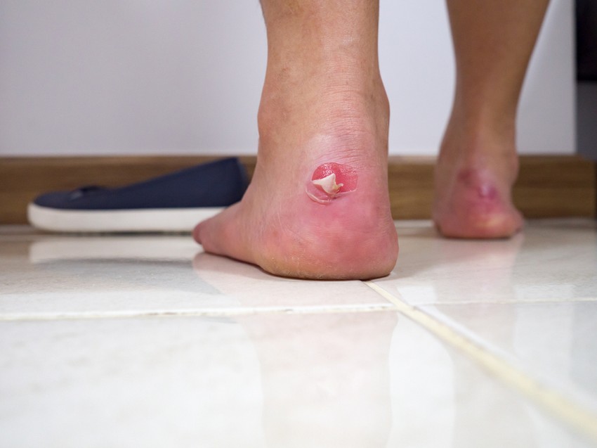 Sportcipők vagy vászoncipők tágításához az alkoholos módszer a legszuperebb. A legjobb etil, vagy denaturált alkoholt használni.