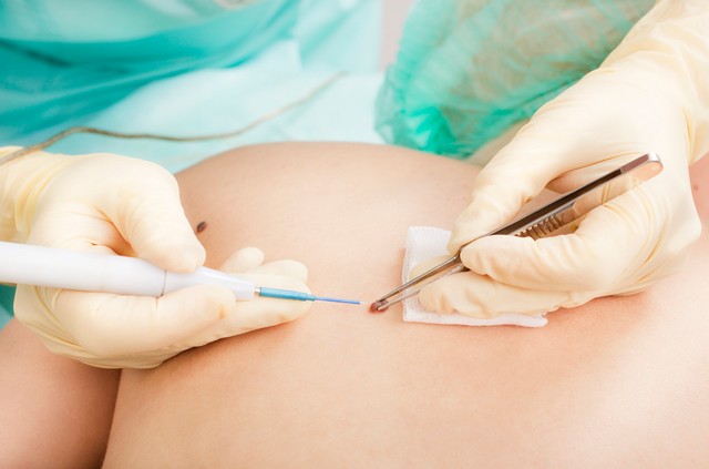 Hogyan történik az anyajegyek eltávolítása? Erre számíthat