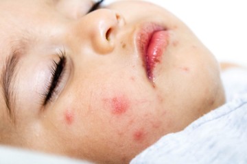 Fájdalmas hólyagok a szájban: ilyen fertőzés is okozhatja!