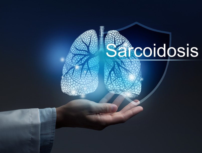 Szarkoidózis