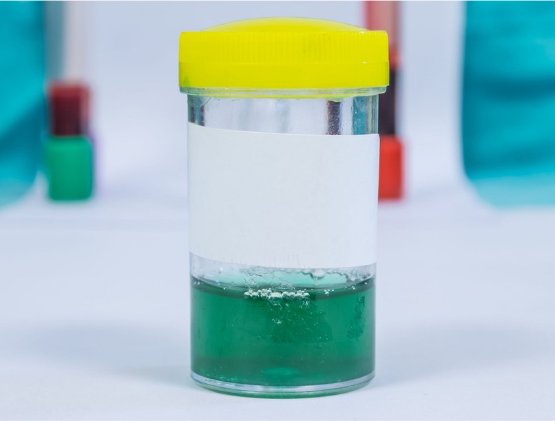 kék zöld vörös barna színű vizelet jelentése