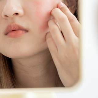 Kipirosodott az orra és az arca a tavaszi naptól? Rosacea is okozhatja című cikk nyitóképe