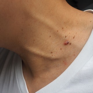 Az ilyen szemölcsszerű bőrkinövések a nyakon előrejelezheti a cukorbetegség egyik típusát a tudósok szerint! című cikk nyitóképe