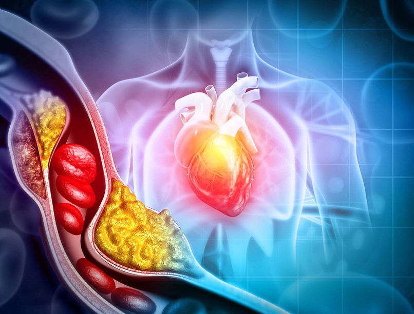 érszűkület, örökölt magas koleszterinszint életmód táplálkozás