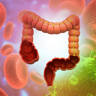 Ennyire komoly betegségeket idézhet elő, ha megbomlik a bélflóránk egyensúlya! című cikk nyitóképe