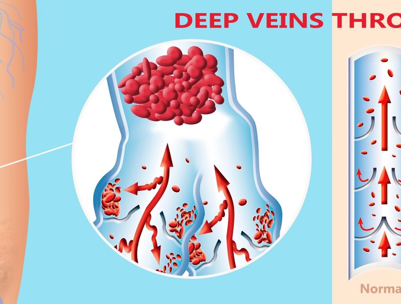 Mélyvénák gyulladása, elzáródása tünet vizsgálat kezelés