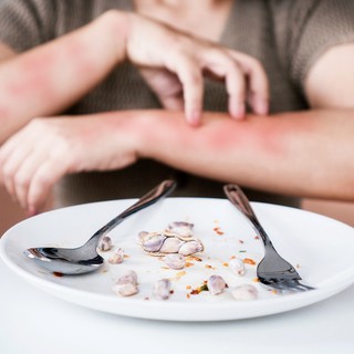 Ételallergia: ilyen, amikor allergiás kiütések jelzik című cikk nyitóképe