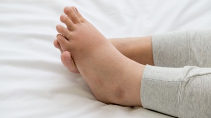 Megdagadt bokák: mikor ártalmatlan és mikor kell komolyan venni? című cikk nyitóképe