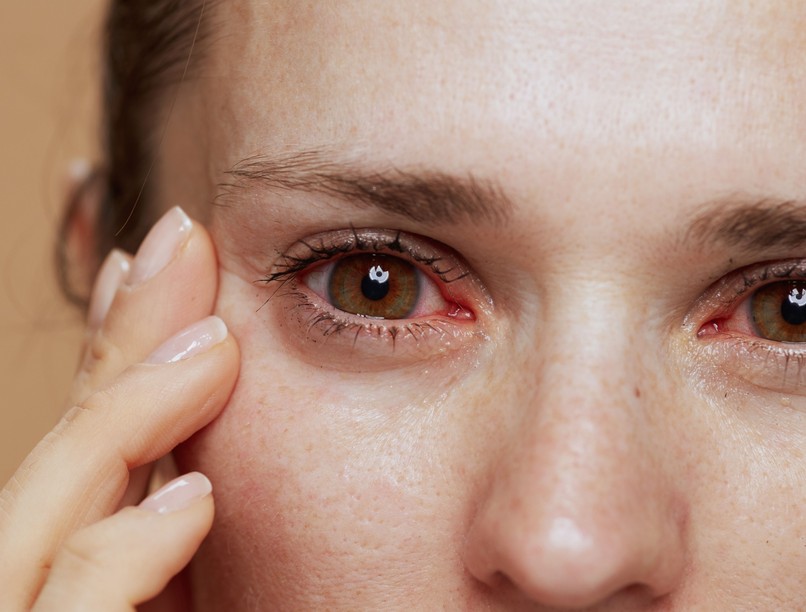 szemviszketés duzzadt szem gyulladás allergia pollen