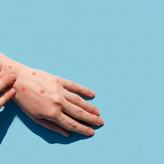 Majomhimlő vagy övsömör? Hasonlóak a tünetek, de van egy fontos különbség köztük című cikk nyitóképe