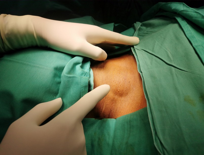 csomóképződés bőr alatti csomó oka