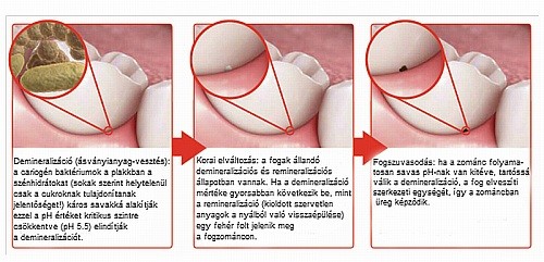Jó lenne öregkorunkban is saját fogsorral mosolyogni?