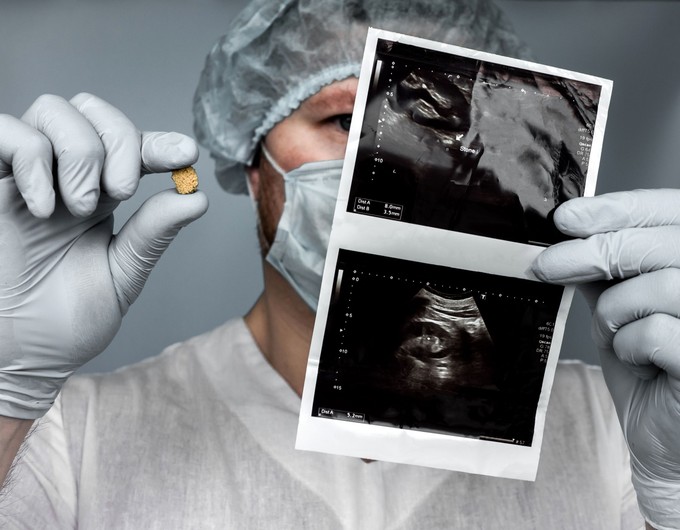 Mitől alakul ki a vesekő? Ez az, amit a háttérben zajló folyamatokról tudnia érdemes című cikk nyitóképe