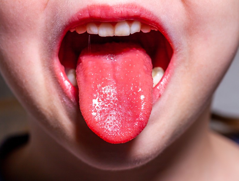 skarlát, nyelv, NNK, tünetei