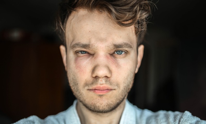 10. Allergiás vagyok/anafilaxiás reakcióm volt, megkaphatom az oltást?