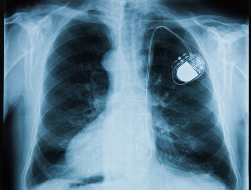 pacemaker, defibrillátor beültetése mikorszükséges