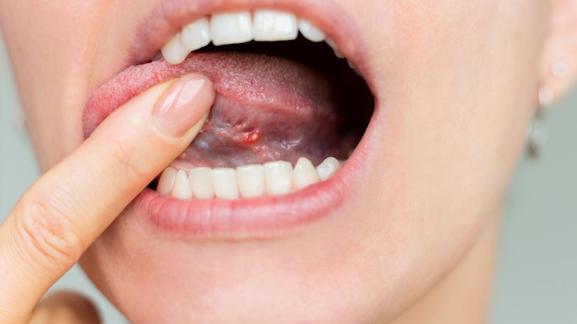 B-vitamin-hiány B12 száj nyelv tünet