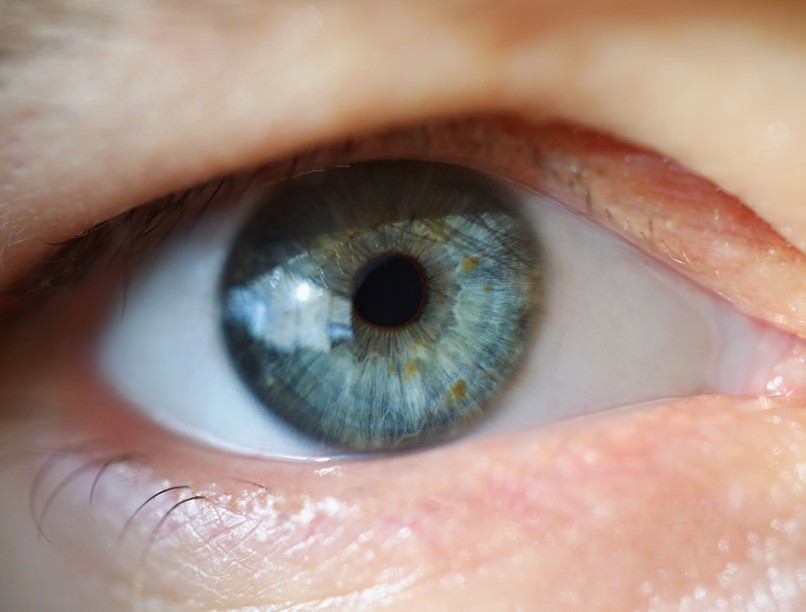 szemhéjcsüngés, mg, tünet, izomsorvadás