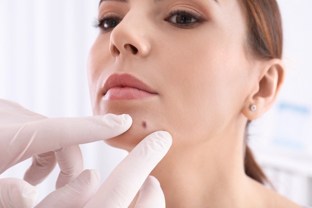 Anyajegy eltávolítás otthon? Gyorsan felejtse el - óvva int a bőrgyógyász!