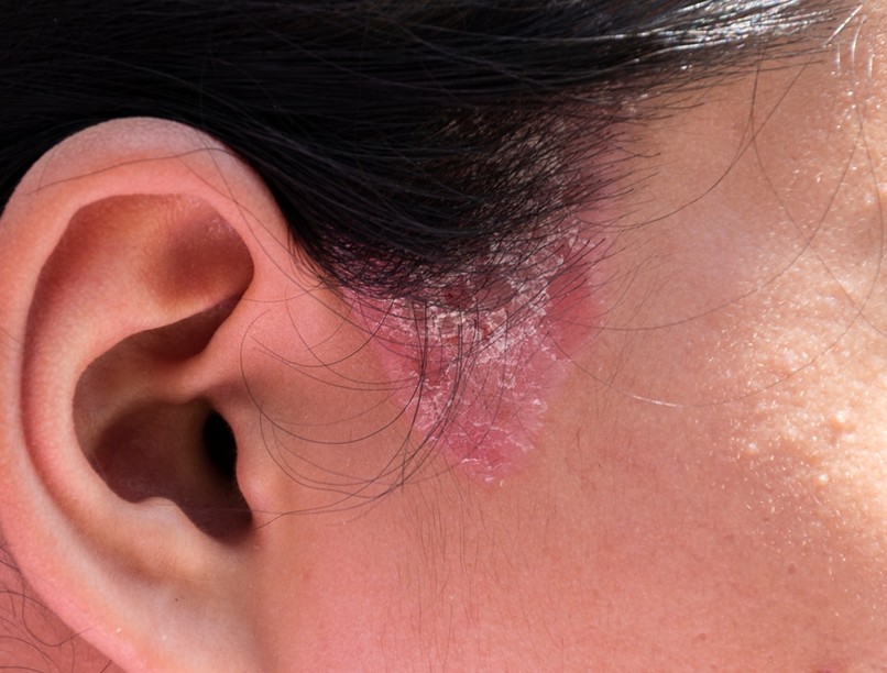 ótvar, orbánc, tályog, bőrbetegség