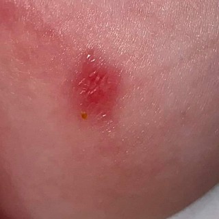 Mire utal a hólyagos bőr? című cikk nyitóképe