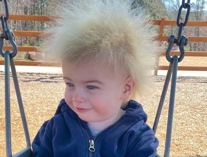 fésülhetetlen haj szindróma, haj, gyerek, száraz haj