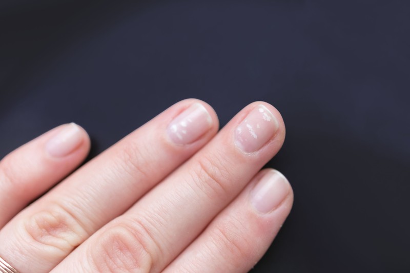 Ha ilyen fehér csíkot, pöttyöt lát a körmén, jobb, ha megmutatja az orvosnak is!