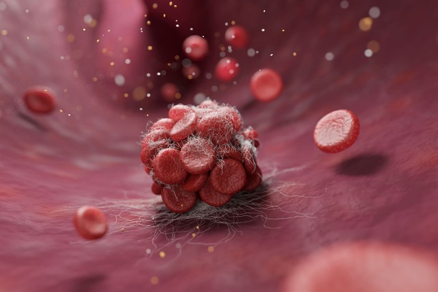 Ez az egy szokás akár az életét is megmentheti – így előzze meg a vérrögöket