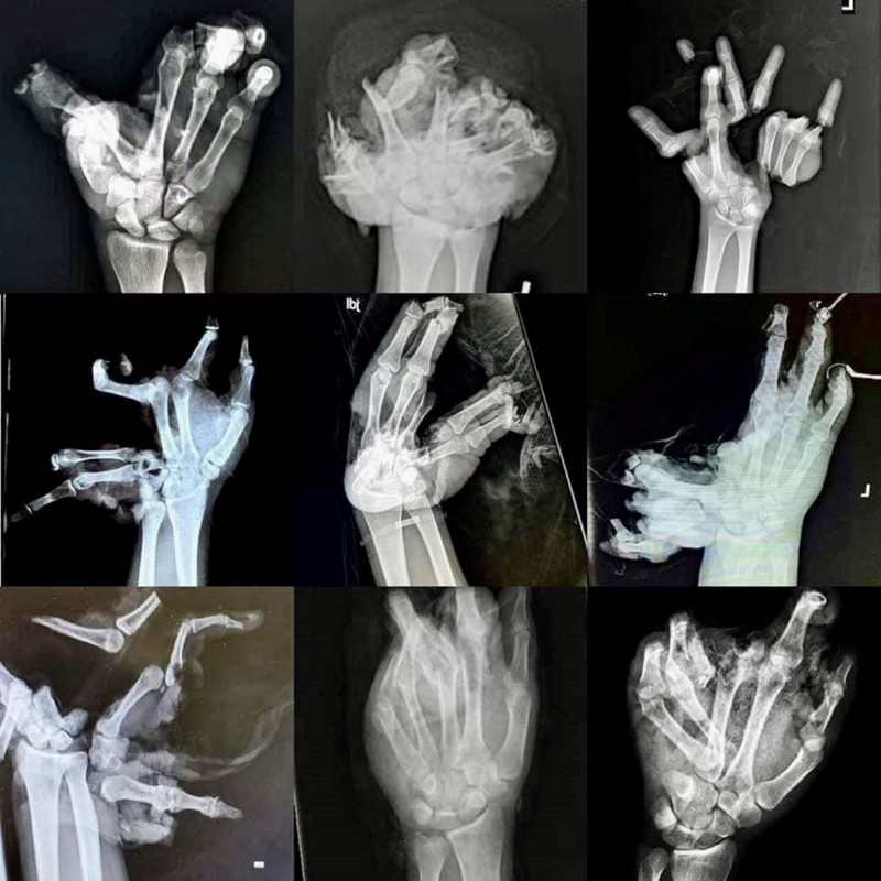 Öncsonkítás lehet belőle: ugye ön sem petárdázik szilveszter éjjel?