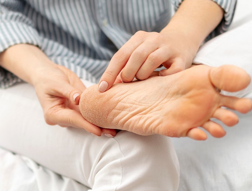 kirepedezett sarok ellen otthon kezelés