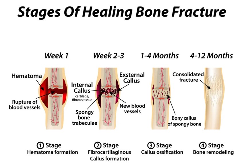 Mikor gyógyul meg egy csonttörés? A törés helyétől és súlyosságát jelző típusától függően általában a törött csont gyógyulása 2-3 hónap gyógyulási időt minimum igényel.