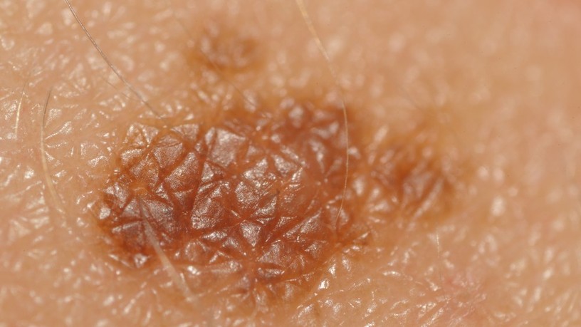 melanoma , melanoma malignum, bőrrák, bőrdaganat, daganattípus