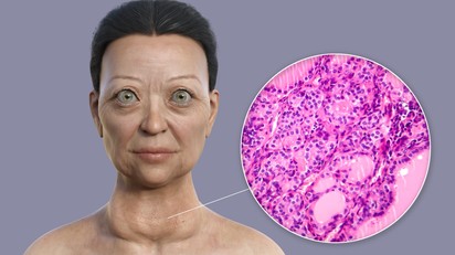 Basedow-kór: tünetei, vizsgálata és kezelési lehetőségei című cikk nyitóképe