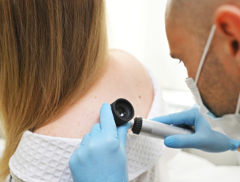 bőrrák, anyajegy, vérzik, tünet, orvos