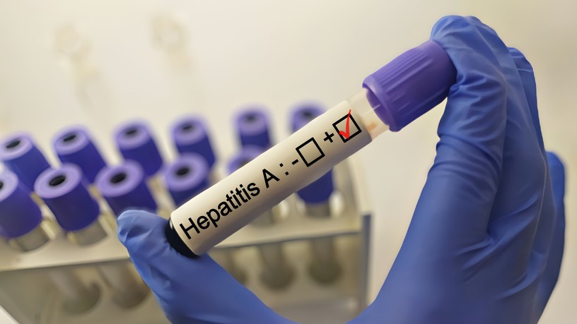 Hepatitisz A